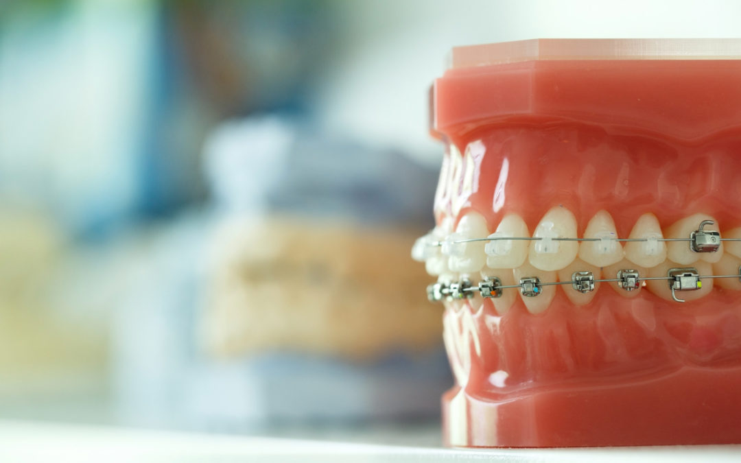 What is an Underbite and How Can it Be Corrected?