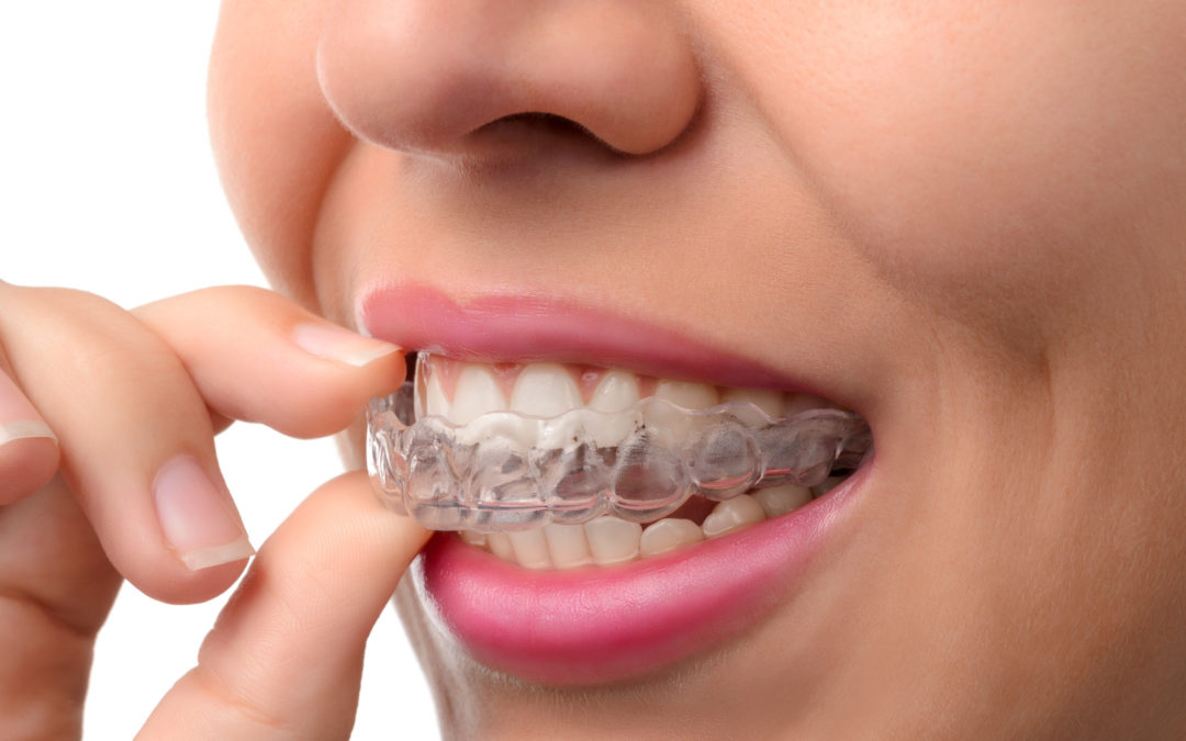 Pros and Cons of Invisalign: Is Invisalign the Right Treatment for Your Teeth?