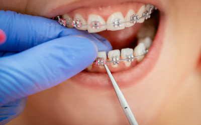 What Is the Best Age to Get Braces?