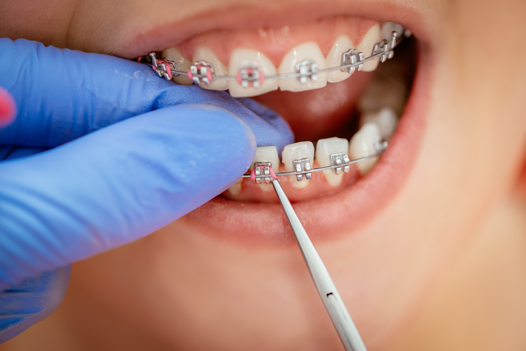 Dental Braces Treatment Details