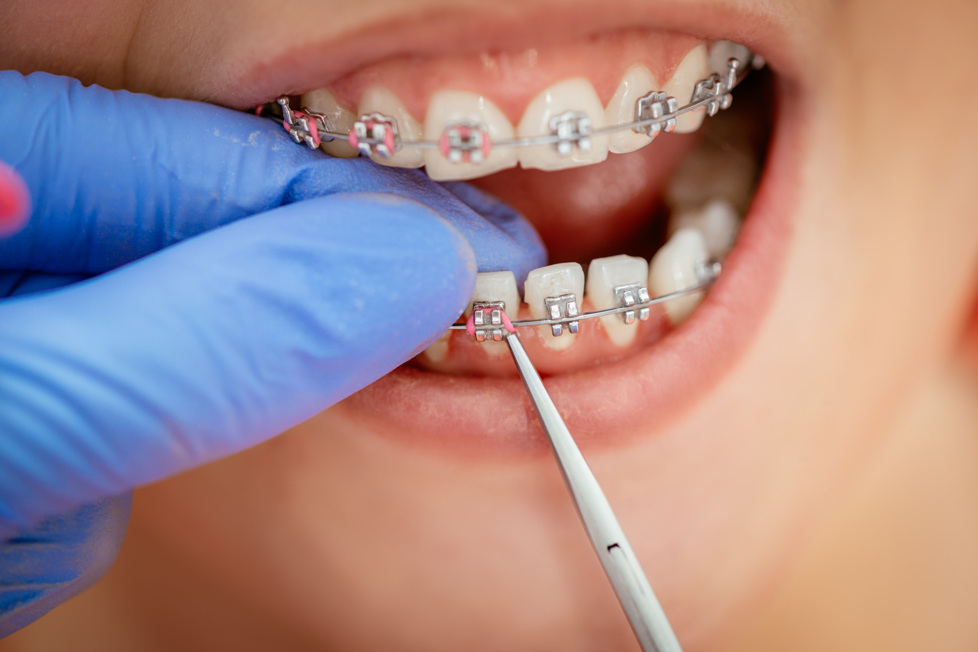 What are Dental Braces?, Orthodontics