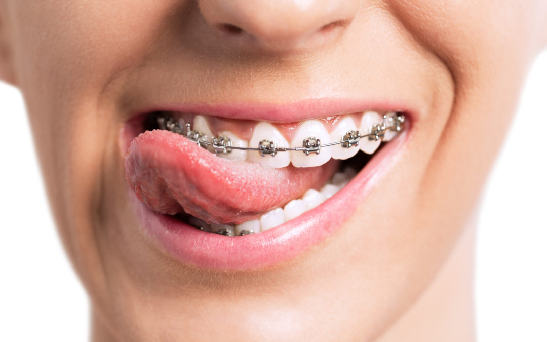 How Are Braces Put On? Everything You Need to Know