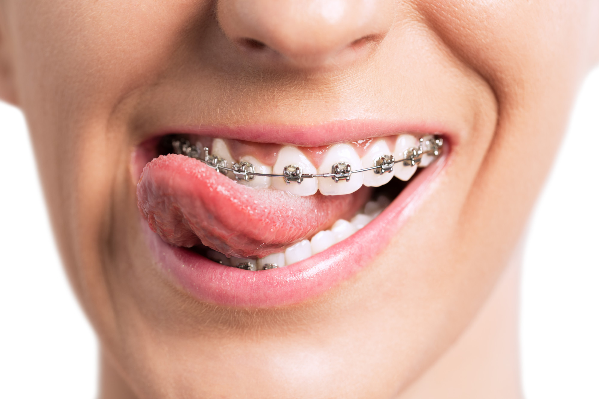 Facts You Need to Know About Clear Braces