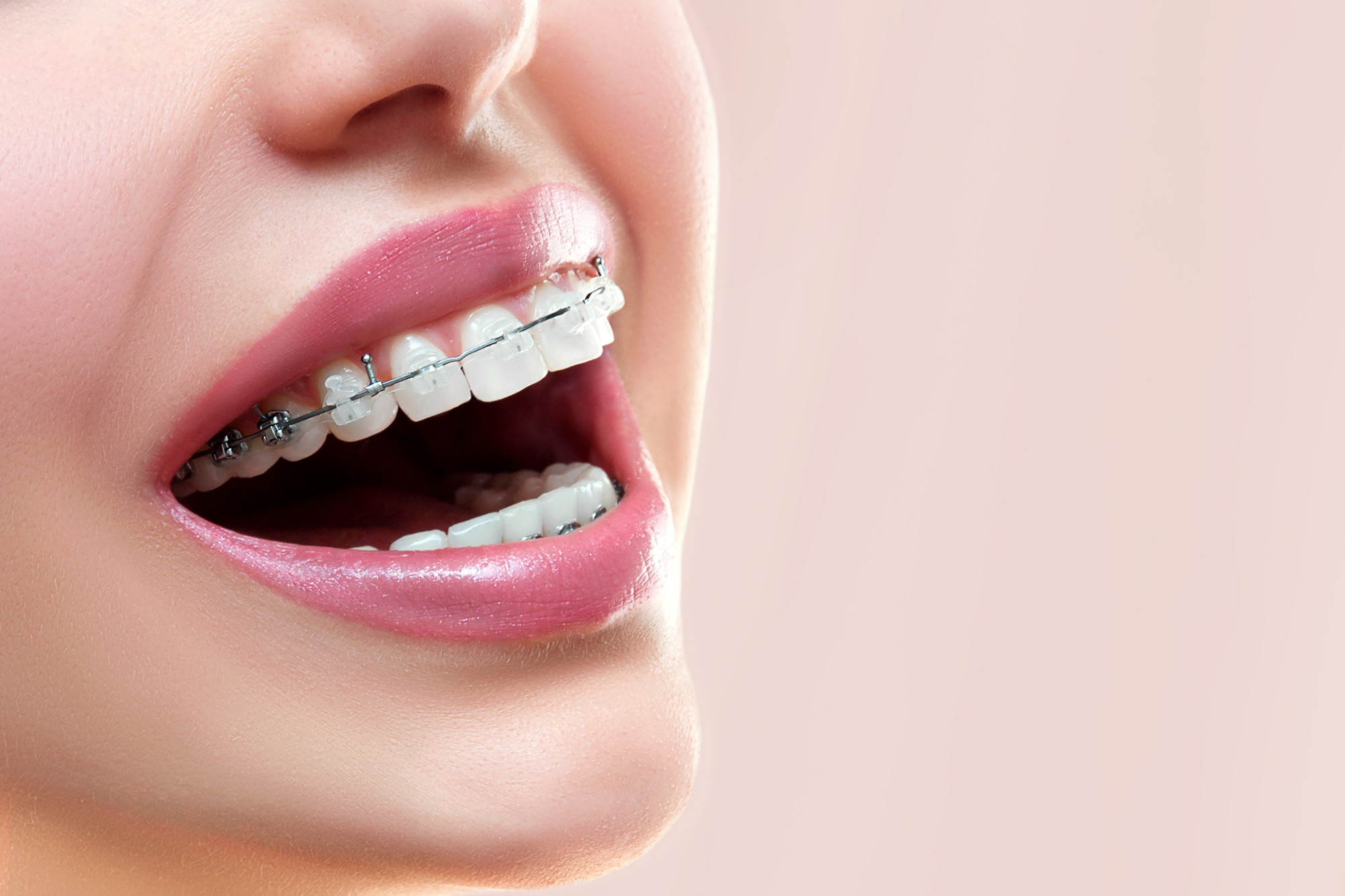 3 Reasons to Get Adult Braces