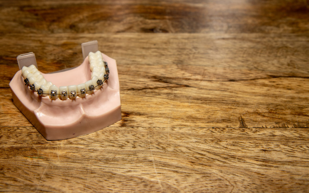 5 Teeth Straightening Options for You to Consider
